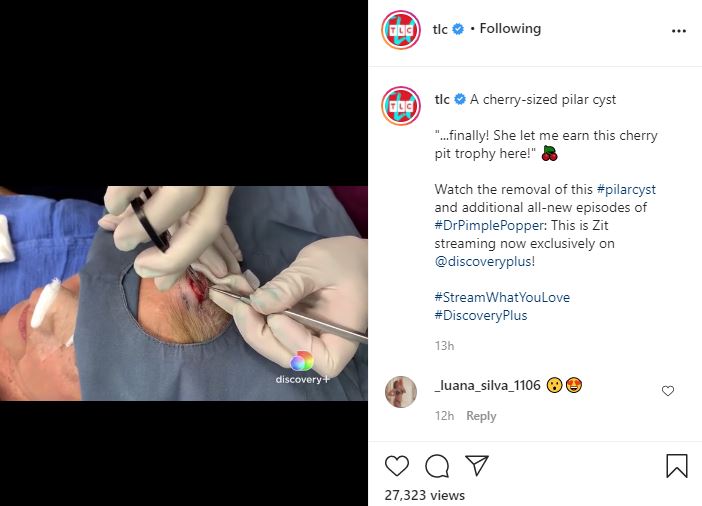 Cherry-sized Pilar Cyst Hard To Swallow On Dr Pimple Popper